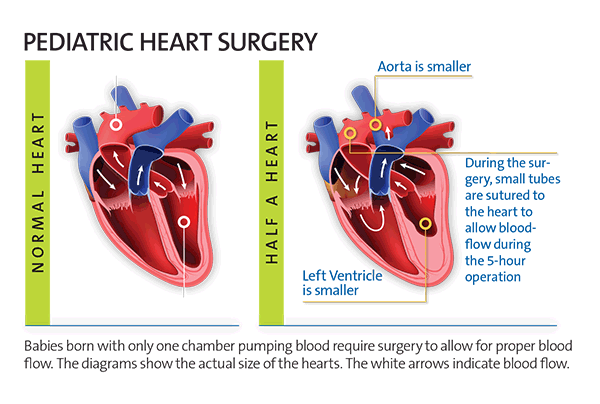 Illustration comparing a normal size heart to a half size heart, which has a smaller aorta and left ventricle