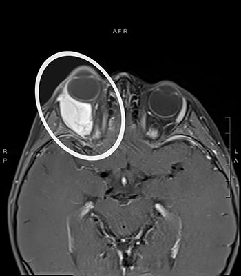 x-ray of conton's tumor behind his eye