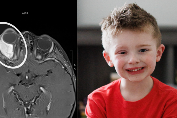 Colton and a scan of the tumor behind his eye