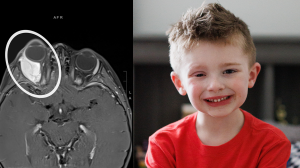 Colton Goodman and an image of the tumor behind his eye