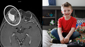 Colton and a scan of the tumor behind his eye
