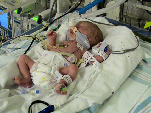 Addie Spancake as a newborn in the NICU